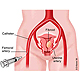 A CASALE IL FIBROMA UTERINO SI OPERA SENZA BISTURI